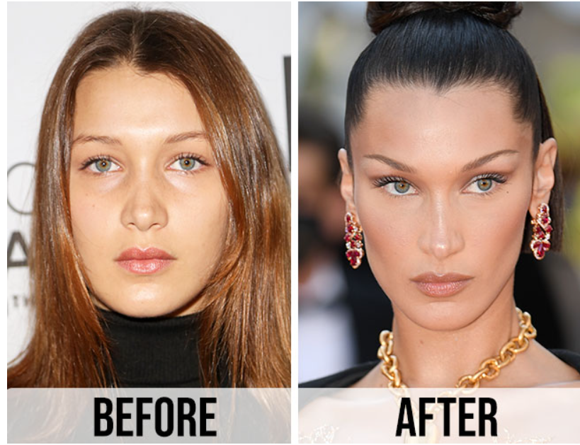 bella Hadid avant apres Rhinoplastie