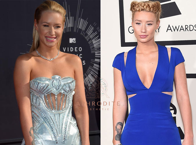 iggy azalea augmentation mammaire photo avant apres