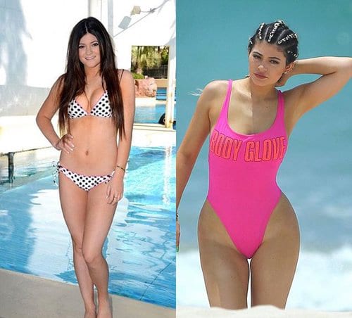 Kylie Jenner cosmetic surgery: Before after surgery