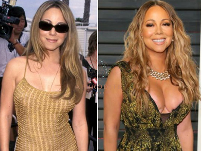 Mariah Carey avant apres l'augmentation mammaire