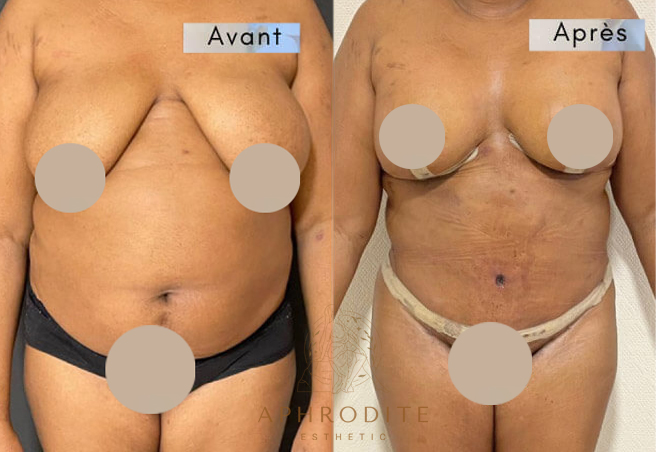 abdominoplastie avant apres