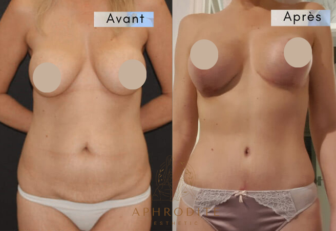 abdominoplastie avant apres