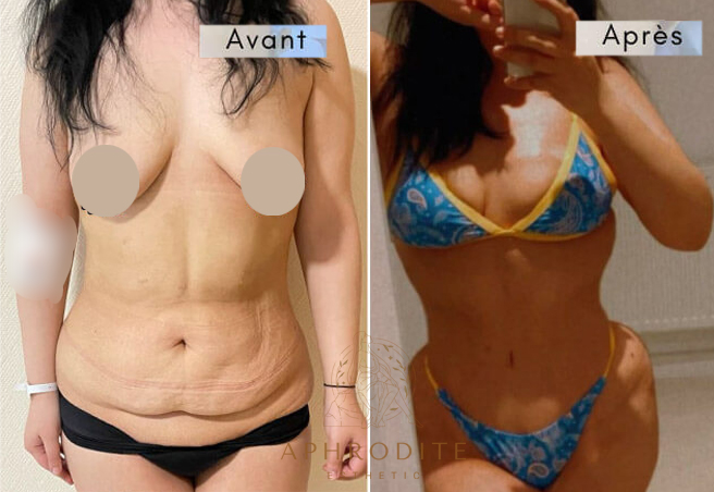 abdominoplastie avant apres