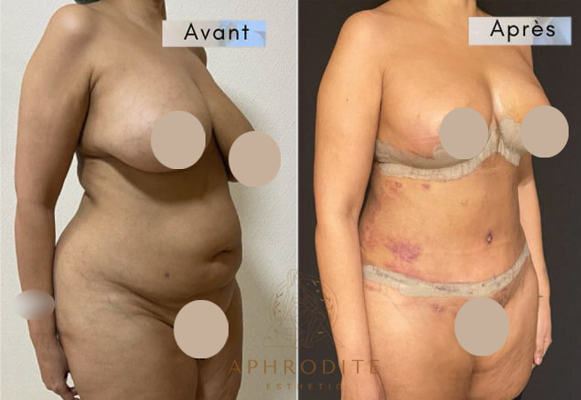 abdominoplastie avant apres