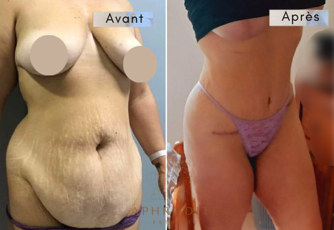 abdominoplastie avant apres