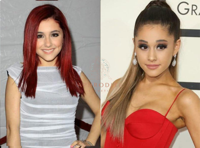 ariana grande chirurgie esthetique des seins