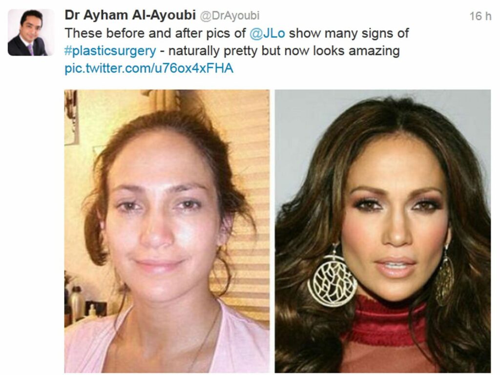Jennifer Lopez : Photo avant/après la chirurgie esthétique selon un chirurgien du visage