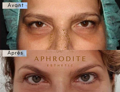 blepharoplastie en Tunisie avant apres