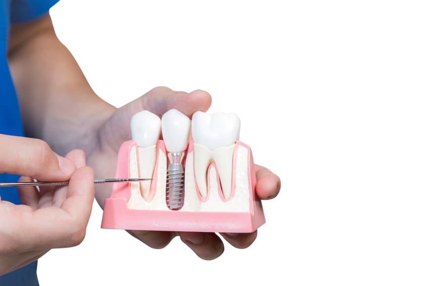 prix implant dentaire tunisie