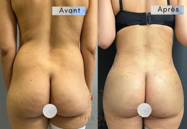 lipofilling fessiers avant apres