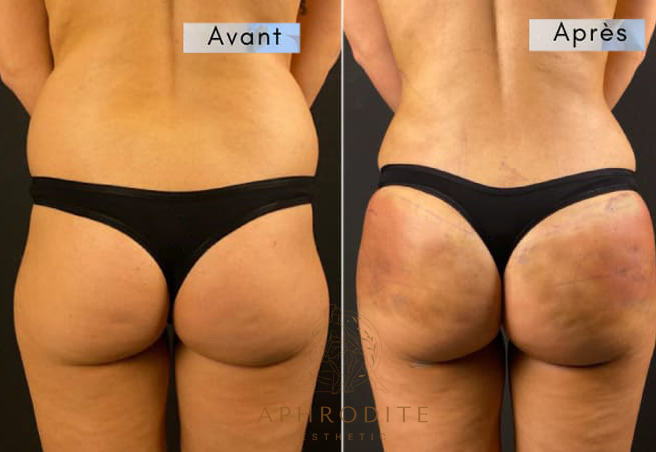 lipofilling fessiers avant apres