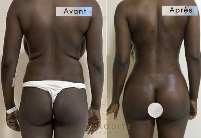 lipofilling fessiers avant apres