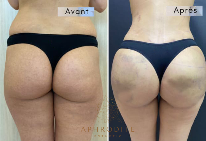 lipofilling fessiers avant apres