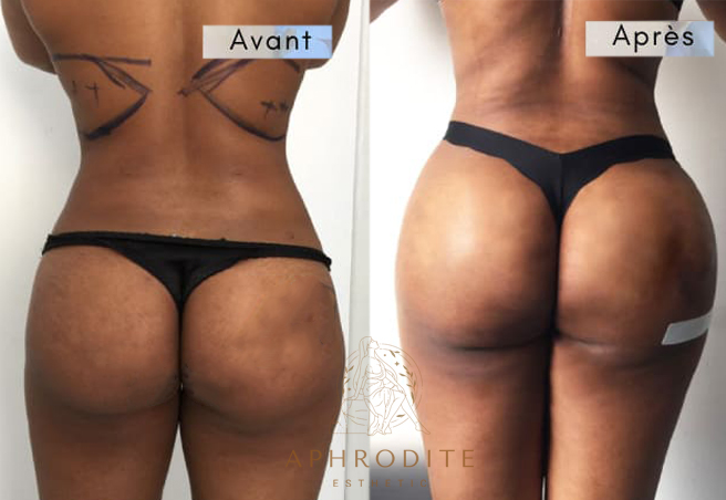 lipofilling fessiers avant apres