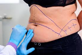 pourquoi-faire-une-abdominoplastie.html