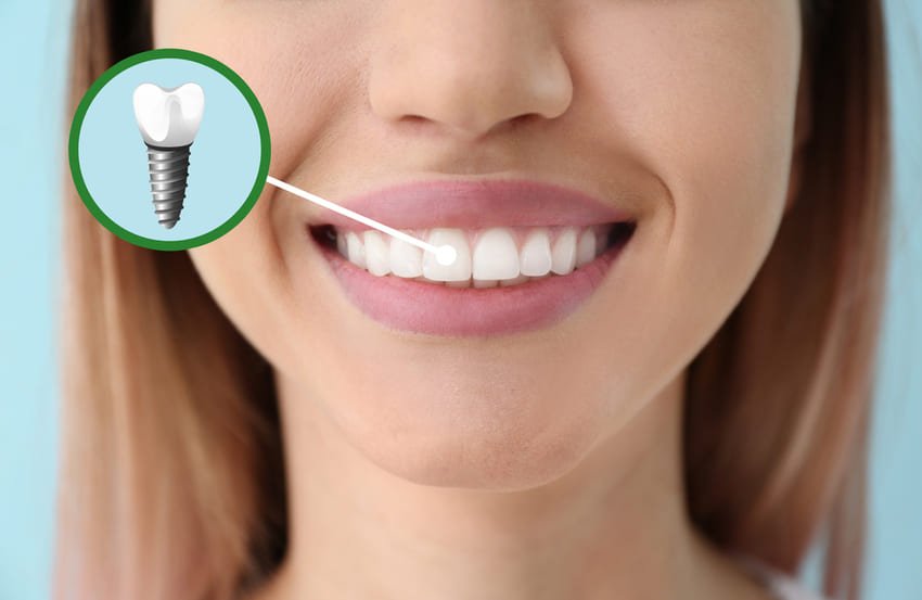 prix Implants dentaires en Tunisie