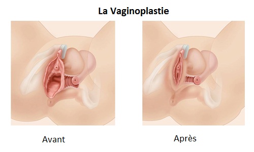 prix vaginoplastie en Tunisie